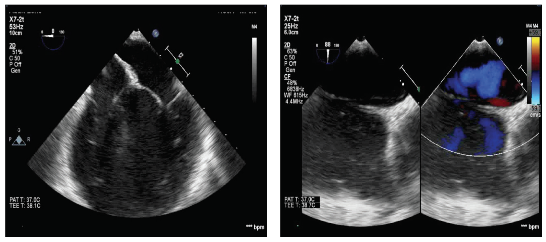 Prominent Eustachian Valve And Unusual Pfo Tunnel Cardiac