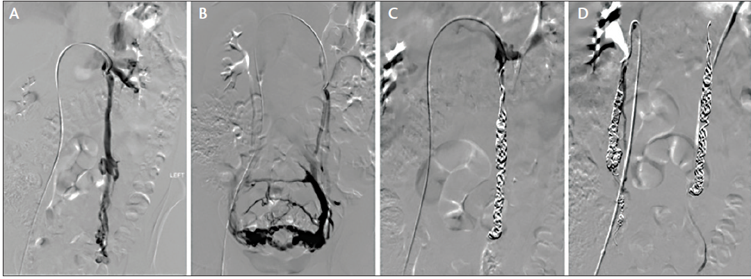 Endovascular Treatment Of Pelvic Congestion Syndrome Endovascular Today