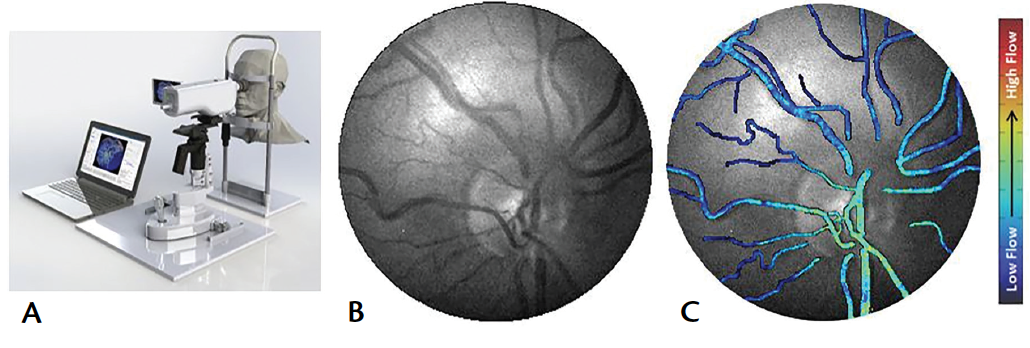 Imaging Options In Retinal Vein Occlusion Retina Today