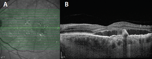 New Ways To Image The Choroid Retina Today