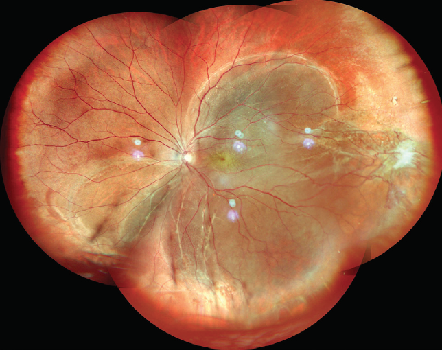 Widefield Multimodal Imaging Retina Today