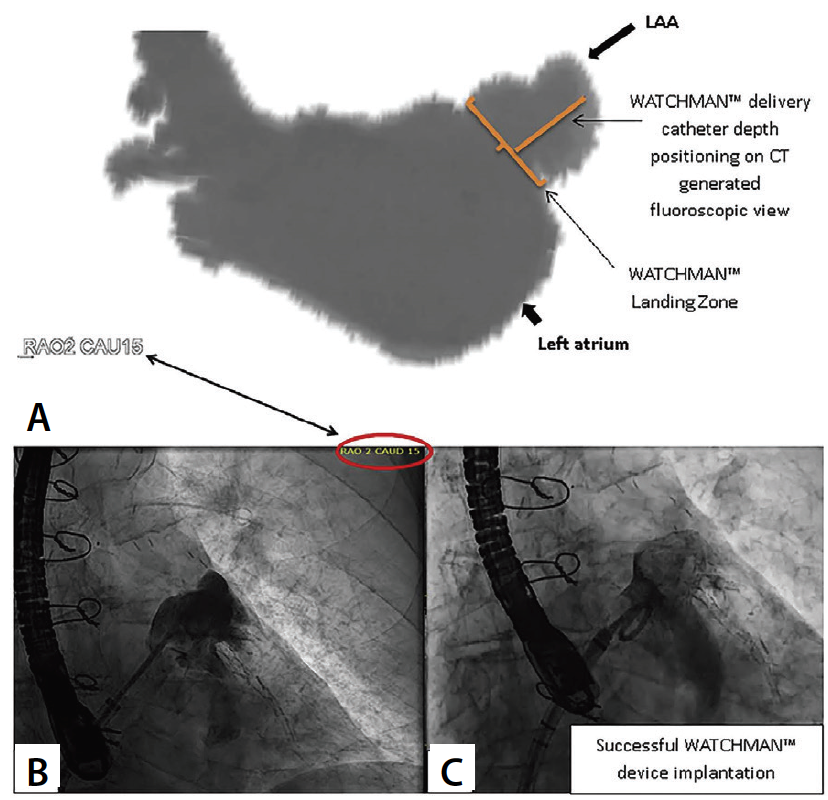 Assessing Anatomy for Left Atrial Appendage Closure - Cardiac ...