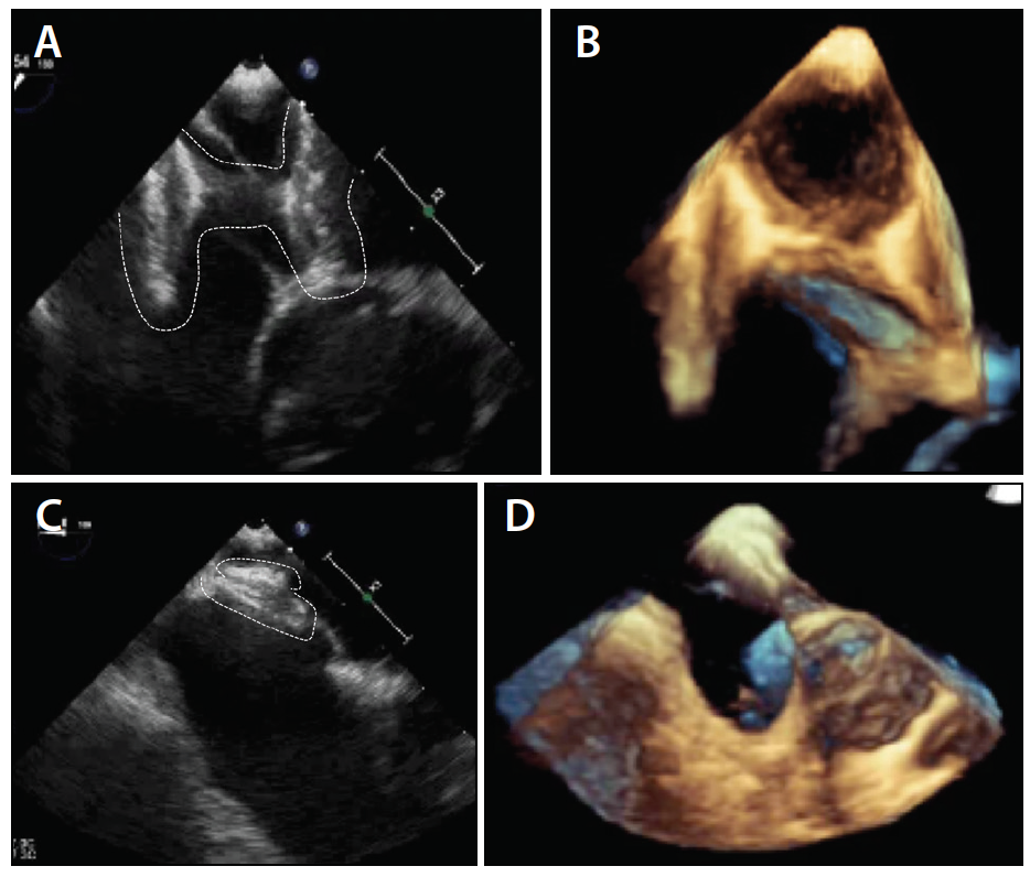 Prominent Eustachian Valve And Unusual PFO Tunnel - Cardiac ...