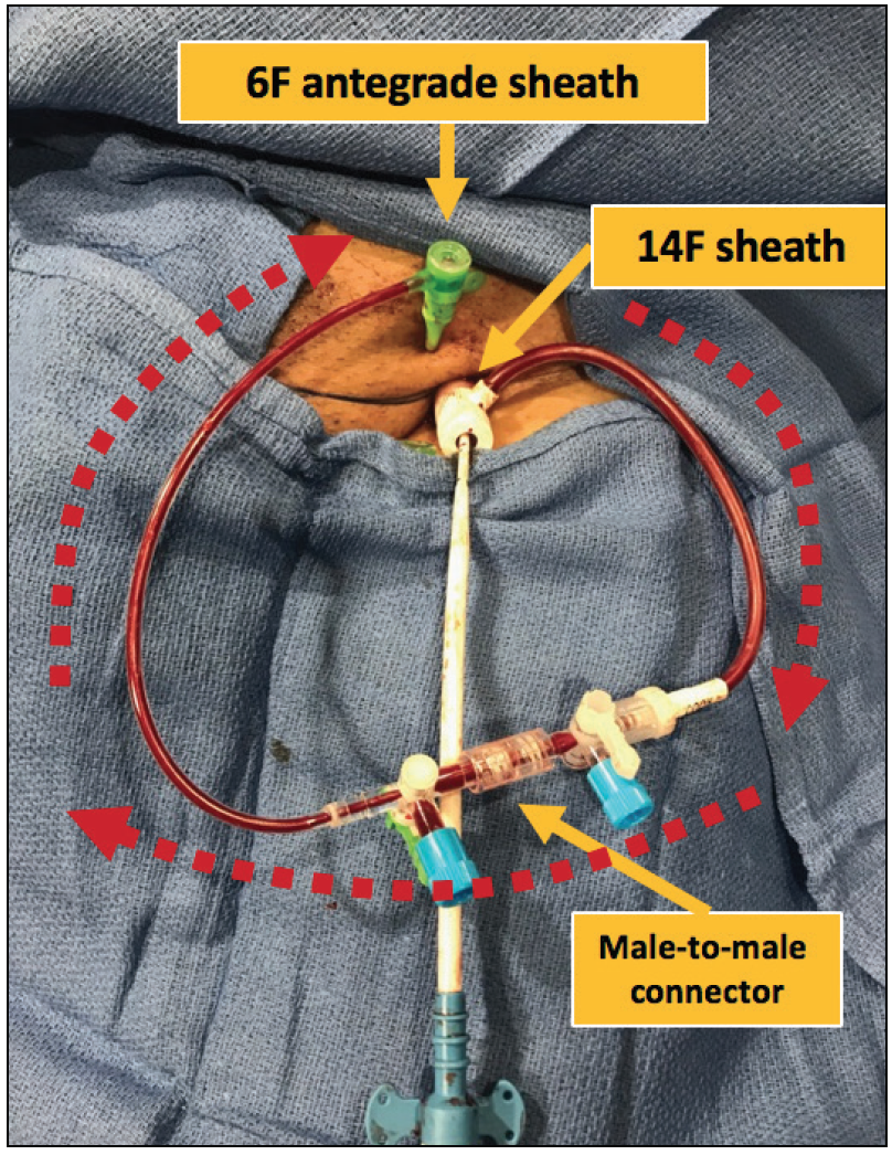 Large-Bore Access Site Management - Cardiac Interventions Today