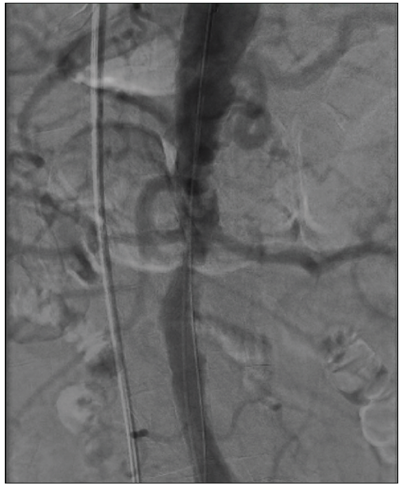 Complex Aortic Transit During CTO PCI - Cardiac Interventions Today