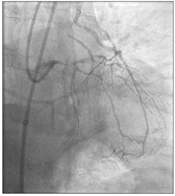 Complex Aortic Transit During CTO PCI - Cardiac Interventions Today