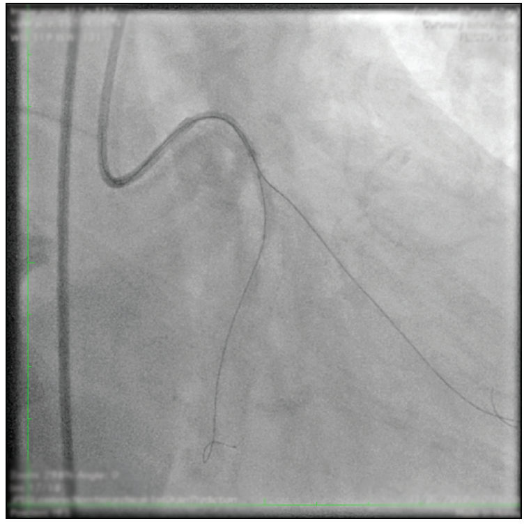 PCI in a Complex Bifurcation CTO - Cardiac Interventions Today