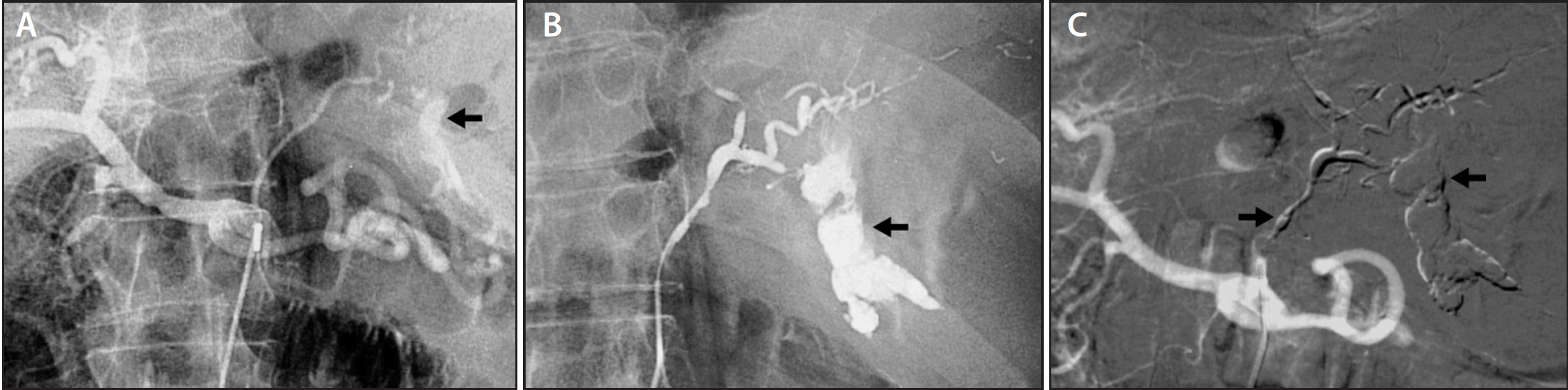 Embolization for Upper GI Bleeding Endovascular Today