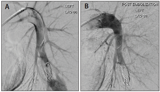 Expand Your Confidence in Embolisation Treatment: Ruby Coil and POD ...