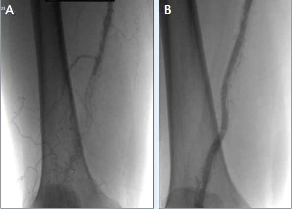 Treating In-Stent Restenosis - Endovascular Today