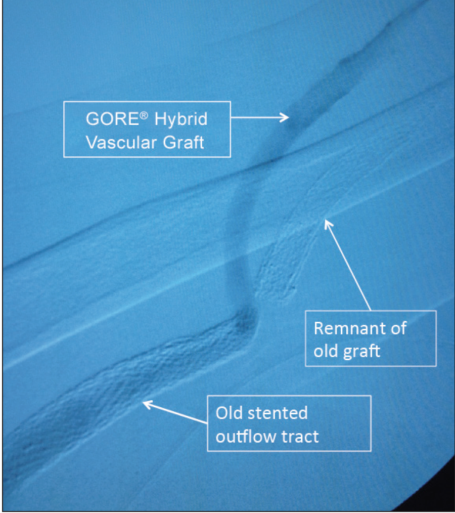 Treating Disadvantaged Venous Anatomy With the GORE® Hybrid Vascular ...