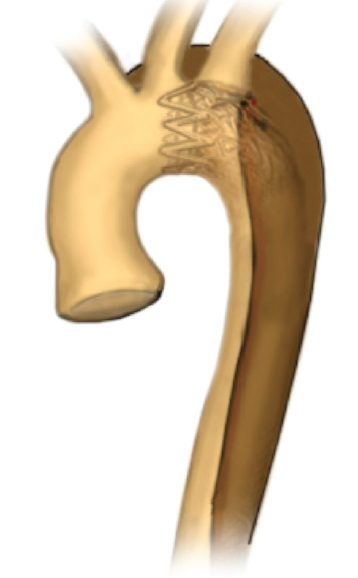 Ask The Experts: If A Complicated Type B Dissection Presents With ...