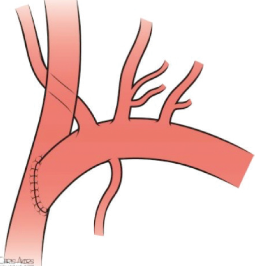 Expanding the Landing Zone for TEVAR - Endovascular Today