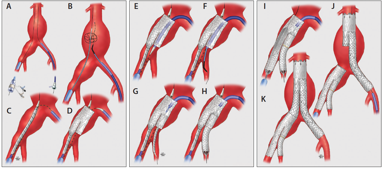 Techniques Of Endovascular Aortoiliac Repair Using An Iliac Branch