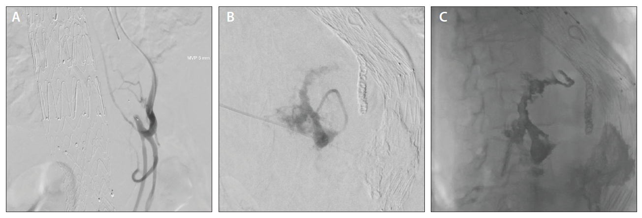 Choosing The Right Option For Treating EVAR Failure: When To Use And ...