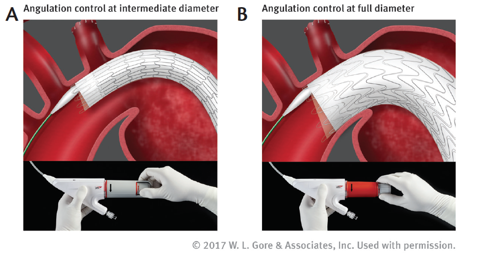 Early Experience Using The Gore® Tag® Conformable Thoracic Stent Graft