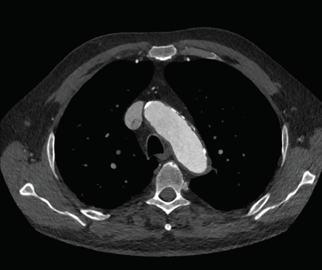 Precision and Accuracy in the Distal Landing Zone Endovascular Today