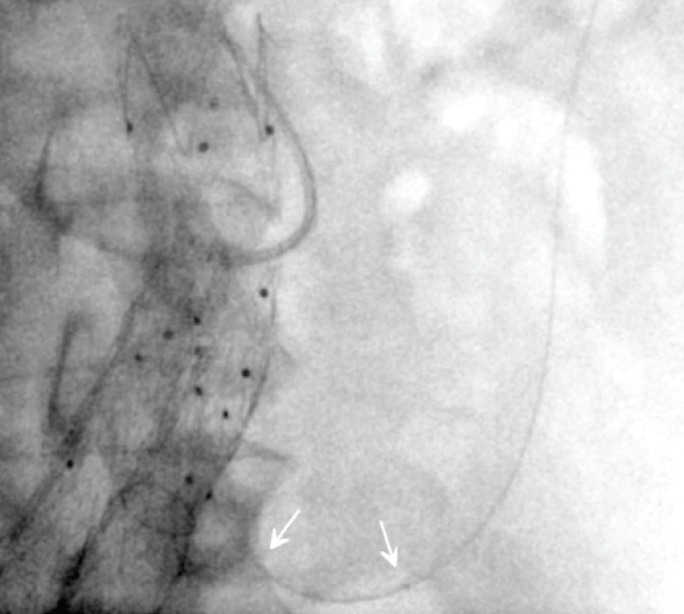 Ruby Coil and POD System: Tools for Dense and Durable Embolisation ...