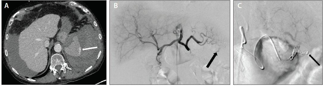 Splenic Artery Embolization: Proximal Or Distal? - Endovascular Today