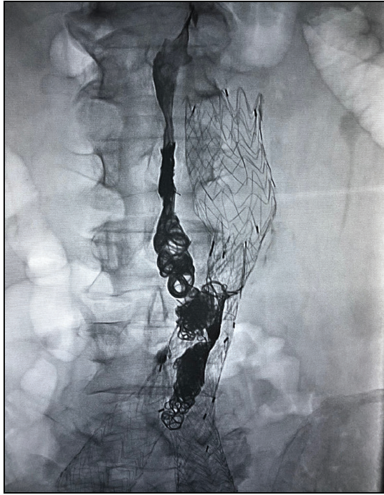 Ruby® Coil and POD® System A Coil Platform for Fast and Easy