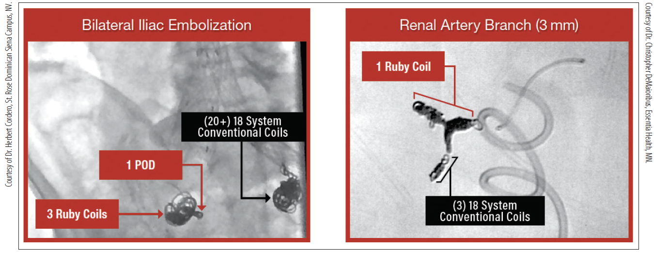 Ruby® Coil and POD® System A Coil Platform for Fast and Easy