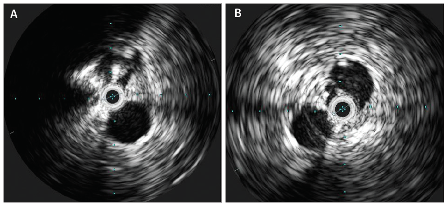 Diagnosing Venous Disease With Ivus How I Do It Endovascular Today