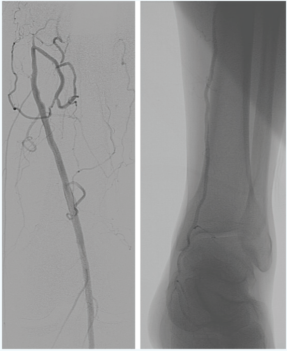 Left Superficial Femoral Artery Occlusion in a Patient With an ...