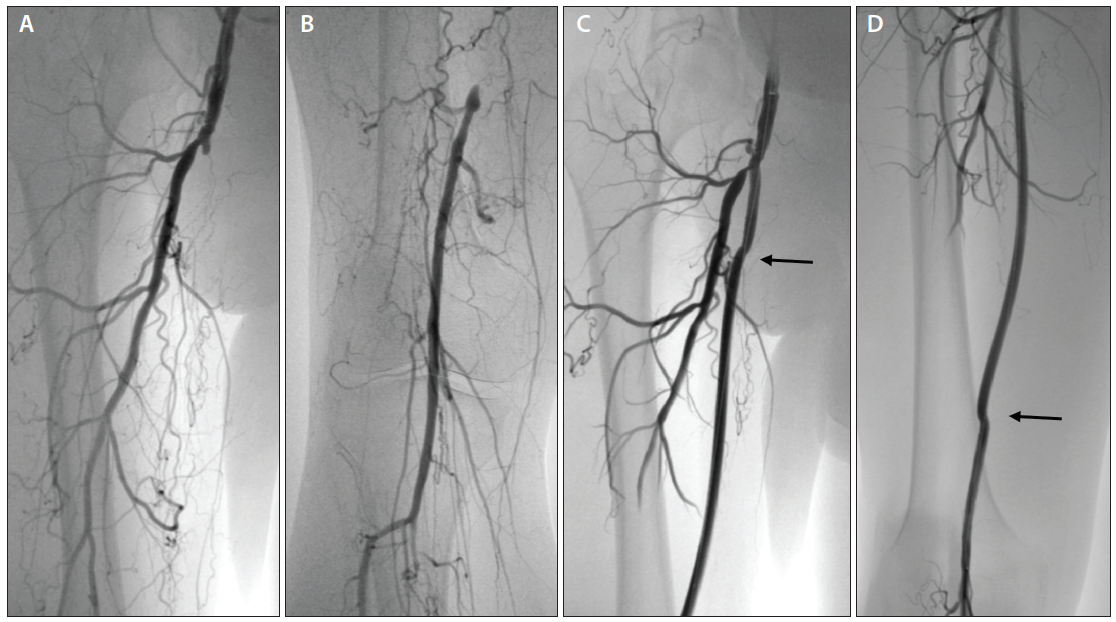 Transforming Open to Endo Percutaneous Bypass as an Option for Long