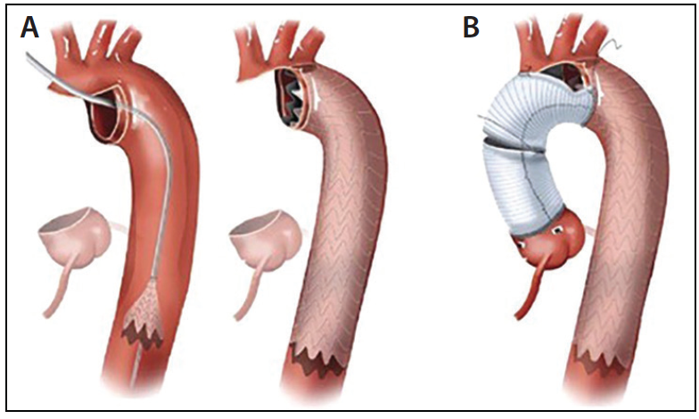 Hybrid Techniques For Surgical Repair Of Acute Type A Aortic Dissection Endovascular Today