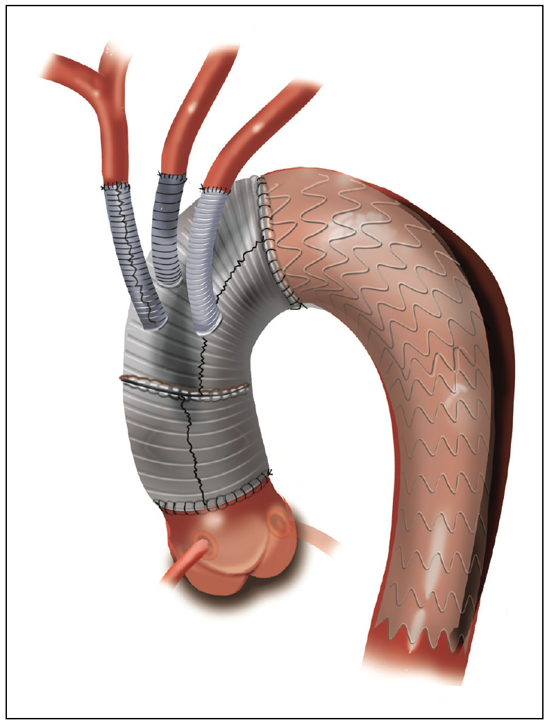 Hybrid Techniques For Surgical Repair Of Acute Type A Aortic Dissection