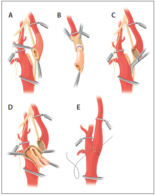 Carotid Endarterectomy: The Eversion Technique - Endovascular Today