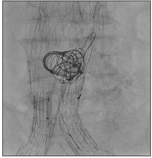 Ruby, POD, and POD Packing Coil Dedicated Devices for Different