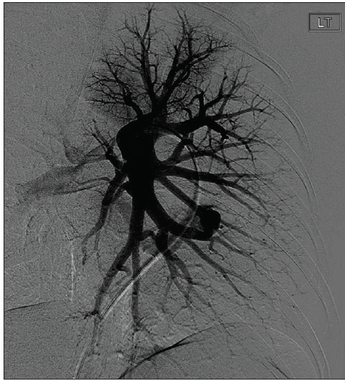 Ruby, Pod, Packing Coil, And Lantern: A Complete Embolization Platform 