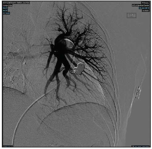 Ruby, POD, Packing Coil, and LANTERN: A Complete Embolization Platform ...