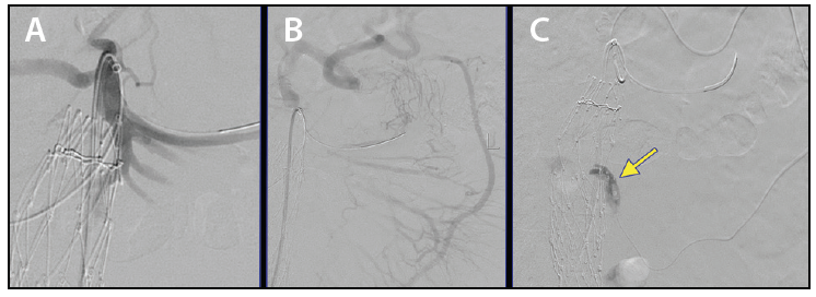 Case Report Embolization Of Transarterial Type Ii Endoleak Using