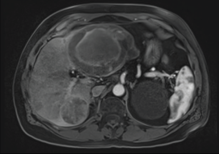 Case Report: Metastatic Neuroendocrine Tumor Using Direxion ...