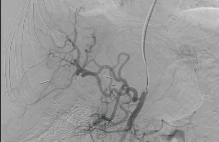 Case Report: Metastatic Neuroendocrine Tumor Using Direxion ...