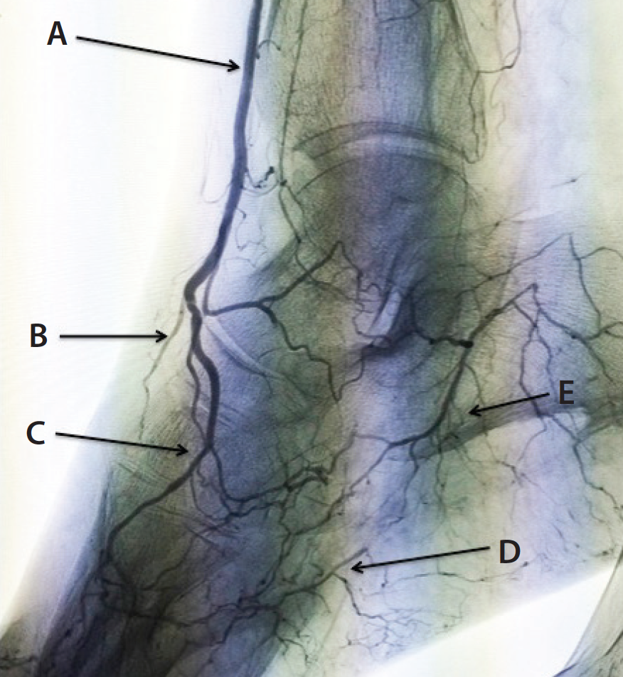 Techniques For Successful BTK Revascularization Endovascular Today techniques-for-successful-btk-revascularization-endovascular-today