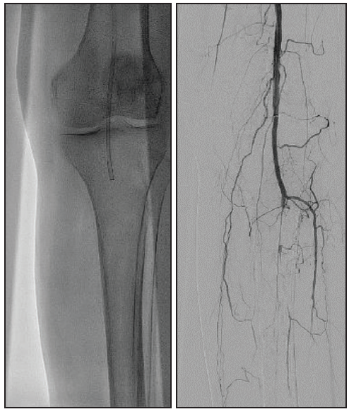 Mechanical Power Aspiration With the Indigo® System: Rethinking Clot ...