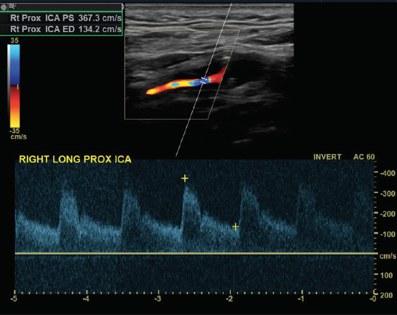 asymptomatic-carotid-stenosis-prior-to-coronary-artery-bypass-grafting