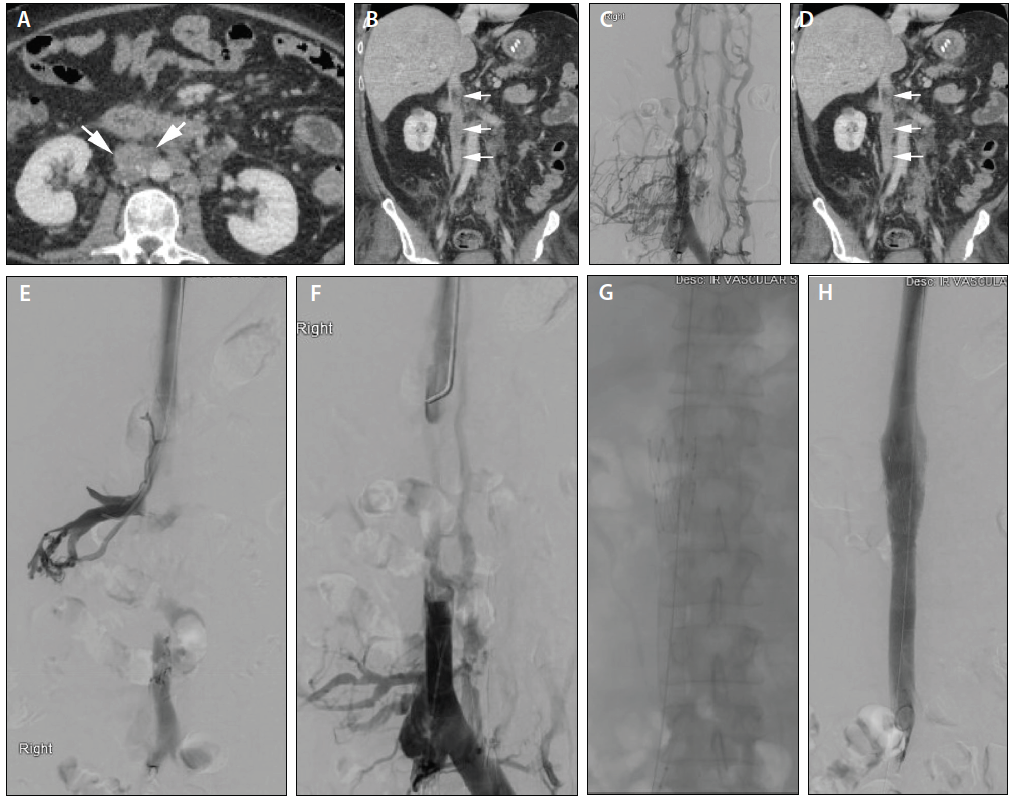 Update on Treatment of Cancer-Associated Thrombosis - Endovascular Today