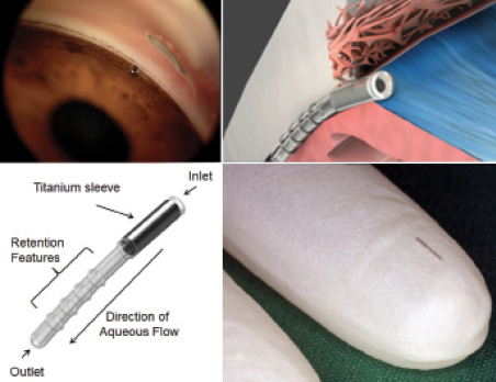 Where We Are Today With MIGS - Glaucoma Today