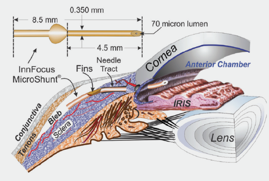 The Year Ahead Glaucoma Today