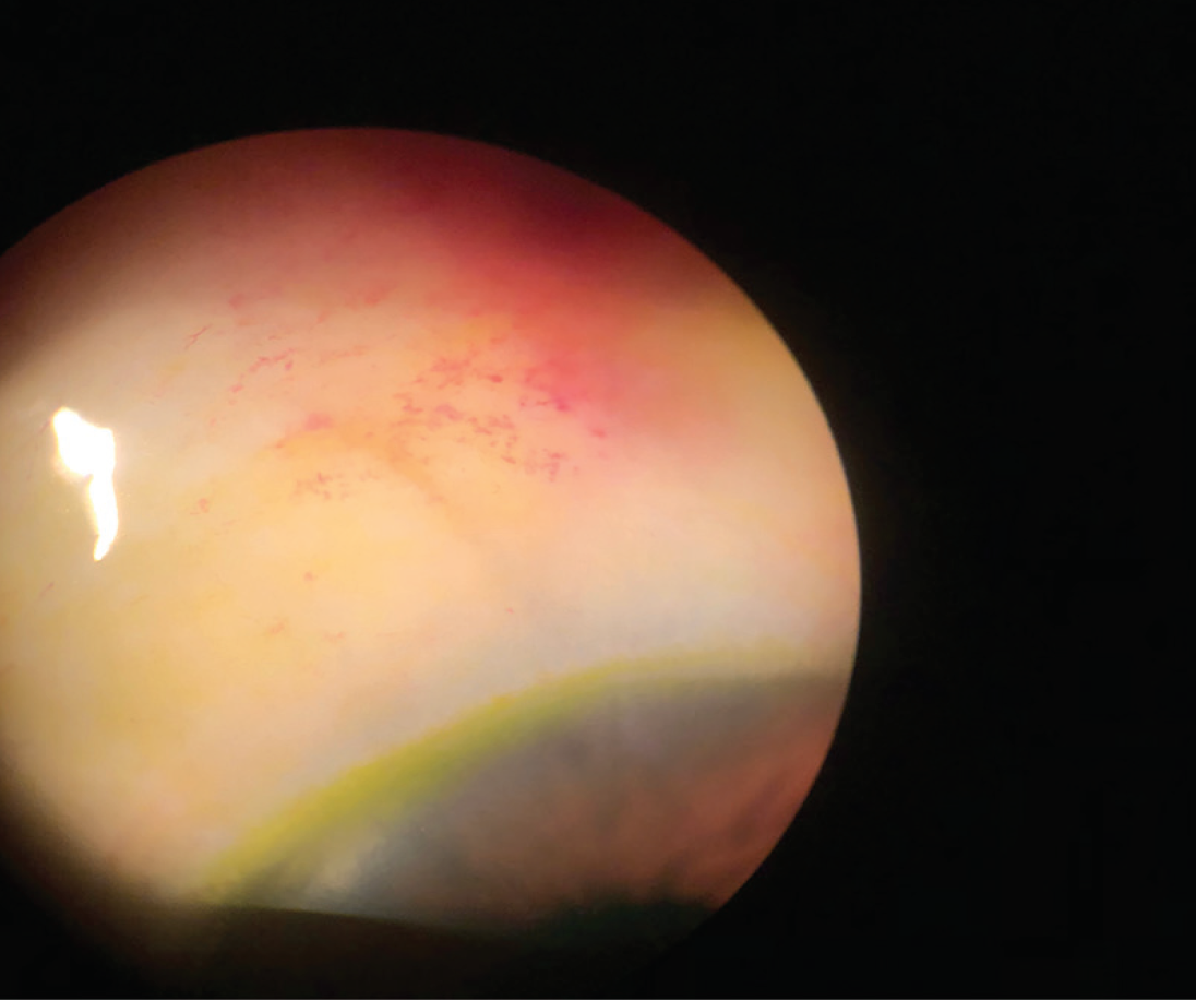 The Xen Gel Stent in Pseudophakic Refractory Patients