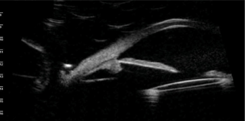 お歳暮ならオンライン Eye an in Syndrome UGH Recurrent With IOL Scleral-Fixated a 健康・医学