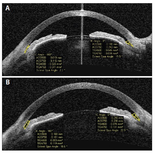 LPI, Iridoplasty, or ECP for Chronic Angle-Closure Glaucoma