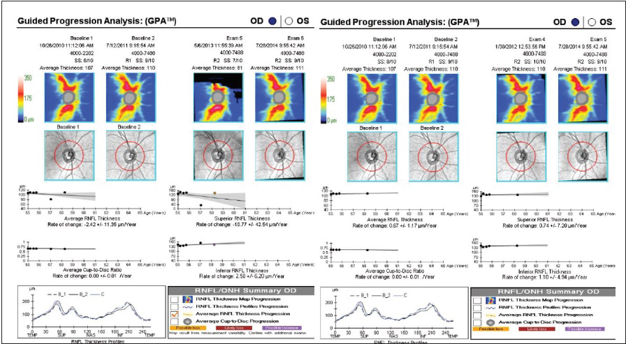 The Art of Detecting Progression on OCT