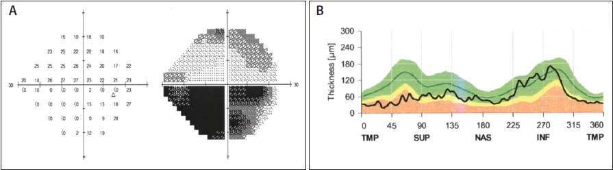 Monitoring Patients With Advanced Glaucoma - Glaucoma Today