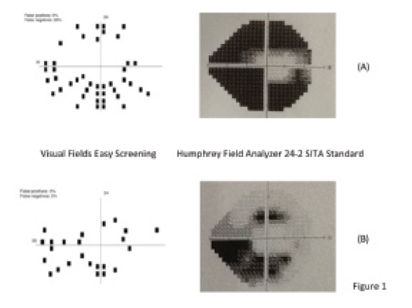 the-next-generation-in-perimetry-glaucoma-today