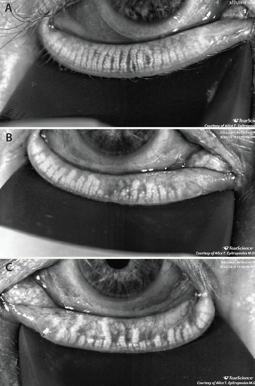 Corneal Imaging - Glaucoma Today